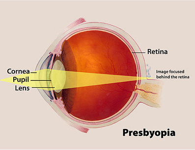 presbyopia, aging eye condition