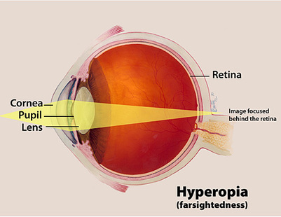 hyperopia farsightedness